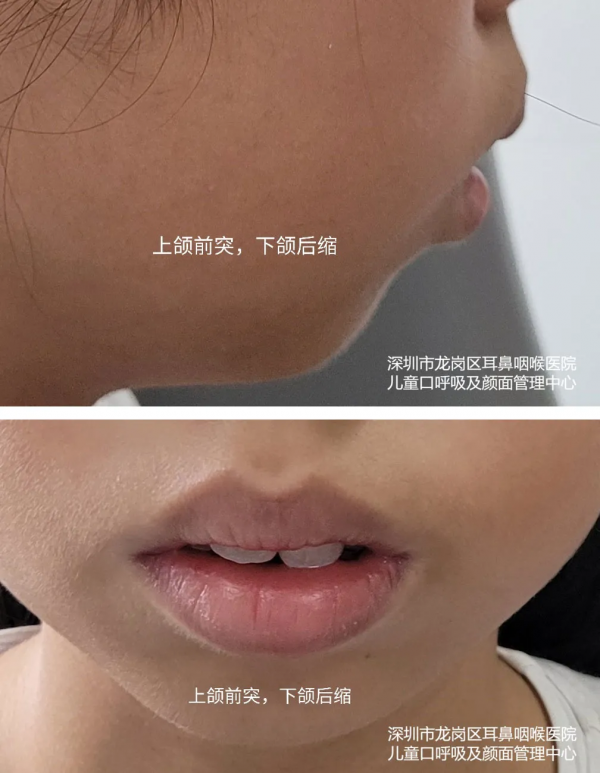 張口呼吸會長歪,用“閉嘴貼”?醫生:胡來! 張口呼吸會長歪,用“閉嘴貼”?醫生:胡來!