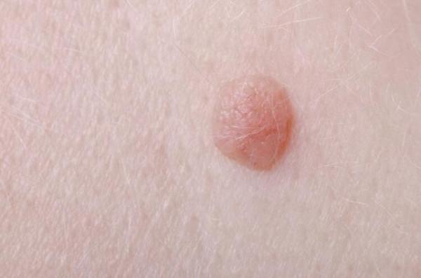 脖子後的“小肉球”是什麼，可以用手直接摳掉嗎？下手前要三思