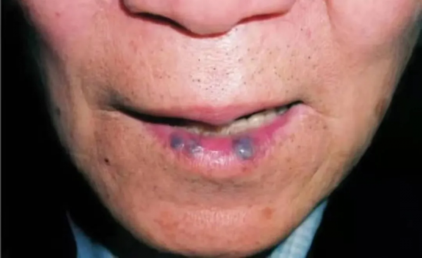 嘴唇上的黑點，擠破後，竟然出了一手血...
