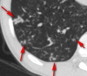 鼻子問題帶出肺病,17歲小夥咳嗽8年,氣管鏡吸出“一斤痰” 鼻子問題帶出肺病,17歲小夥咳嗽8年,氣管鏡吸出“一斤痰”
