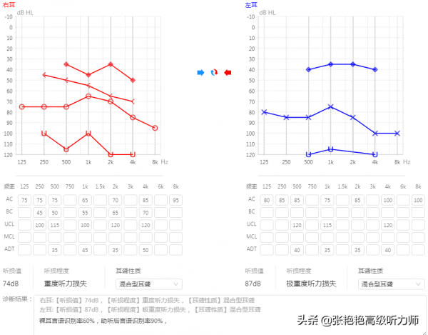聽見但聽不清，驗配師說言語識別率差，那還有必要佩戴助聽器嗎？