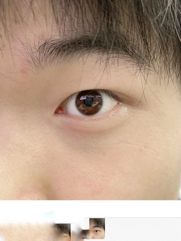 兄弟們！這個去黑眼圈的方法一定要知道