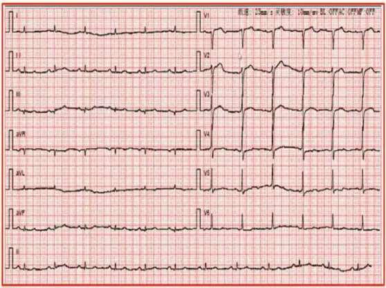 體檢查出&OpenCurlyDoubleQuote;竇性心律&rdquo;是啥意思？心律不齊是心臟病嗎？總算明白了