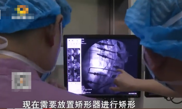 11歲“麻花女孩”李潔智力低於2歲，後背植入30顆螺釘，後來怎樣