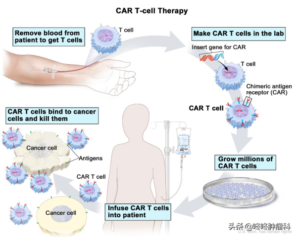 CAR-T治療進軍血液腫瘤一線方案！療效驚豔完全緩解率達78%