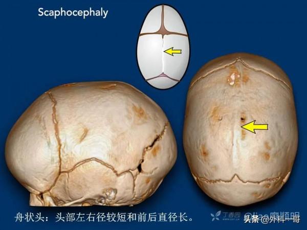 小兒顱縫早閉的診斷治療