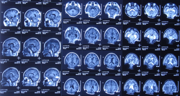 顱內生殖細胞瘤切除術後腦積水仍反覆,意識模糊,左側肢體偏癱 顱內生殖細胞瘤切除術後腦積水仍反覆,意識模糊,左側肢體偏癱