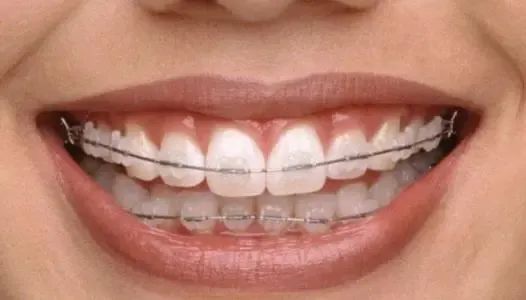 正畸不清潔 當心留爛牙