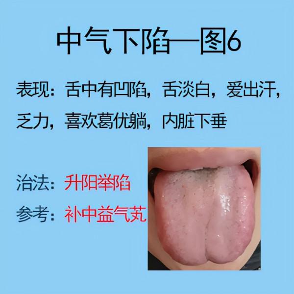 脾胃不好常見6種舌象，比如脾氣虛，脾陽虛等，後面有解決方法
