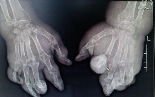 患痛風20年不忌口，全身長滿了痛風石！提醒：尿酸高別吃3類食物