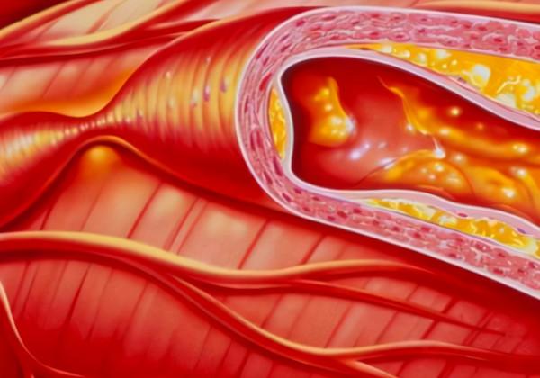 豬油渣到底是血管的“良藥”還是“殺手”？不妨聽聽醫生的答案