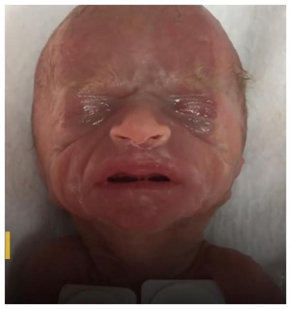 26周早產兒，出生不到1斤只有巴掌大，奇蹟生還長成大美人