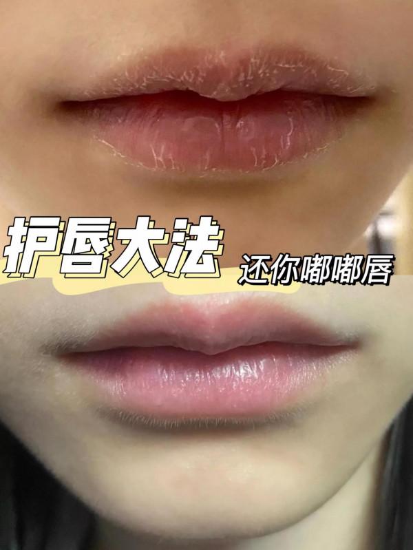 不能忽視的嘴唇護理丨唇部問題乾貨分享