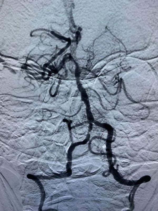 【為群眾辦實事】北京友誼醫院（通州院區）多學科合作成功搶救一例急性基底動脈閉塞患者