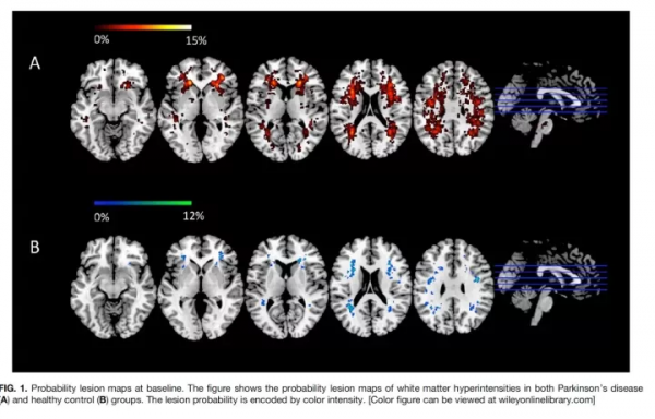 腦科學日報：預防帕金森病，DNA疫苗有望步入臨床