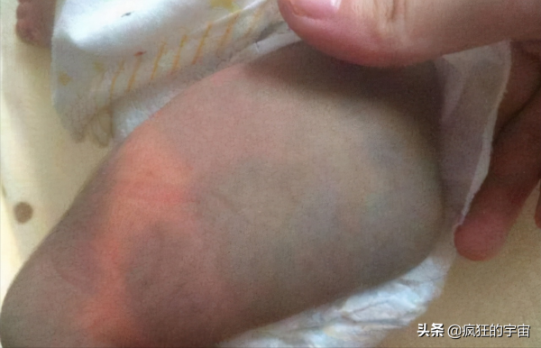 為啥很多剛出生的嬰兒屁股上都有“淤青“?答案終於來了 為啥很多剛出生的嬰兒屁股上都有“淤青“?答案終於來了