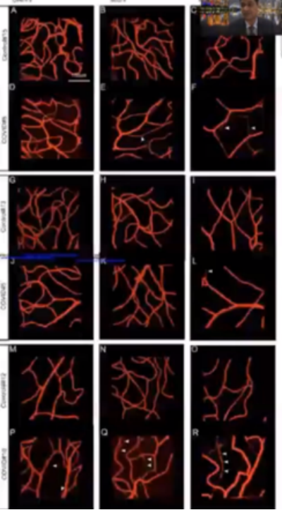COVID-19眼部感染，何為真？何為假？丨APVRS 2021