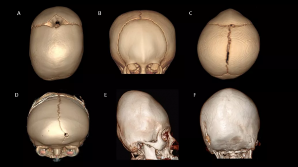 頭皮和顱骨病變的影像學特點 頭皮和顱骨病變的影像學特點