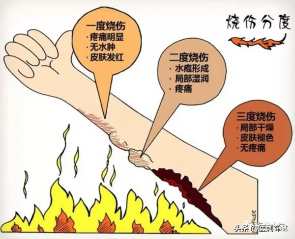 水火燙傷方 水火燙傷方