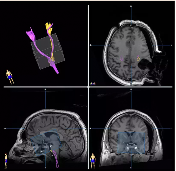 手術全切,3年未復發,1歲多幼兒如何鬥過腦幹膠質瘤“惡魔”? 手術全切,3年未復發,1歲多幼兒如何鬥過腦幹膠質瘤“惡魔”?