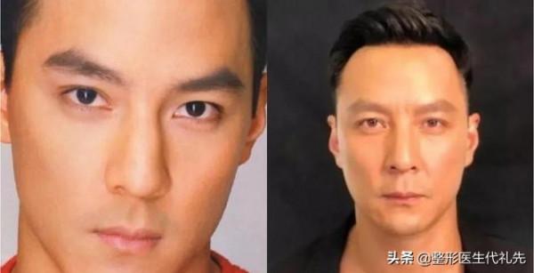 從整形醫生角度談一談人中長顯老，該如何改善？