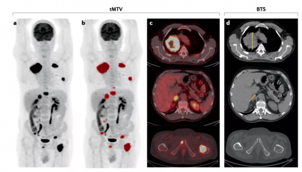 腫瘤負荷，腫瘤突變負荷，別再傻傻分不清啦