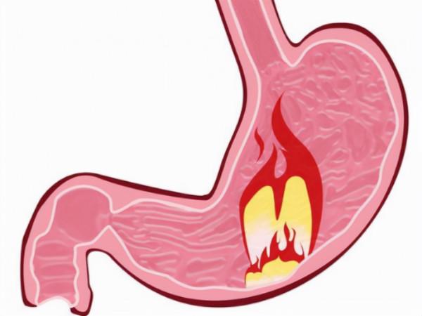 奧美拉唑、蘭索拉唑、泮托拉唑、雷貝拉唑有何區別？哪個作用最好