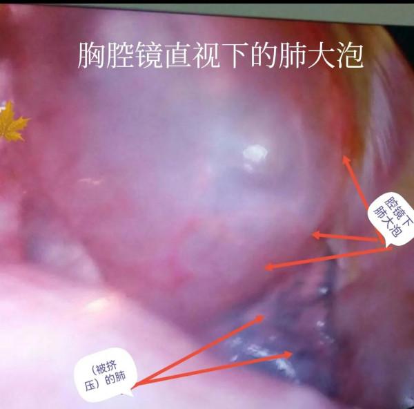 肺大泡相關（診治）問題