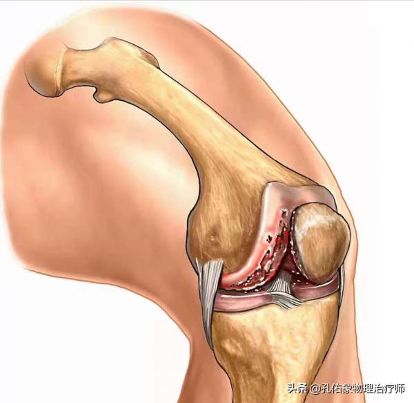 膝關節疼痛的元兇是什麼?骨性關節炎嗎?要如何應對?請看此文 膝關節疼痛的元兇是什麼?骨性關節炎嗎?要如何應對?請看此文