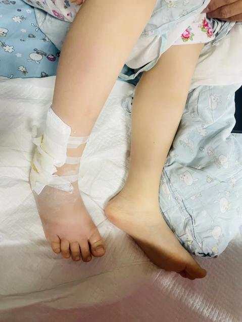 6歲男孩突然腳腫還發燒，竟是因大冬天被蚊子咬了一口