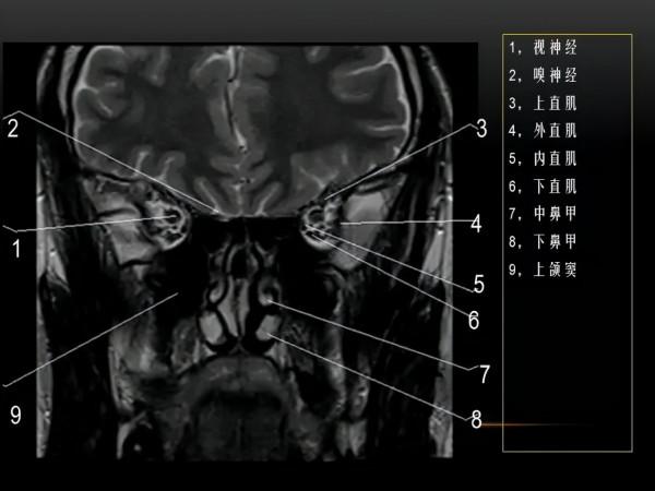 MRI下眼部及鼻竇解剖