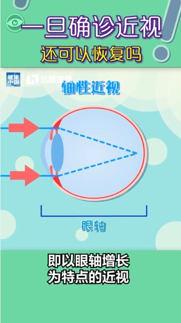 孩子近視都是電子產品惹的禍？近視有沒有可能恢復？權威解答在此，值得收藏