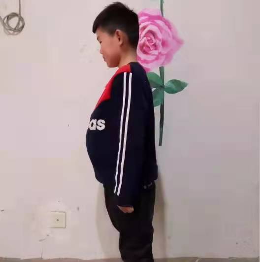 ​“70萬一針的天價藥進醫保”背後,這種罕見病費用更高河南患者最多 ​“70萬一針的天價藥進醫保”背後,這種罕見病費用更高河南患者最多