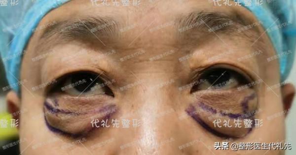 最值得35~70歲男士做的眼周年輕化術式－外路祛眼袋手術