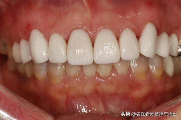 美麗前牙再煥發青春