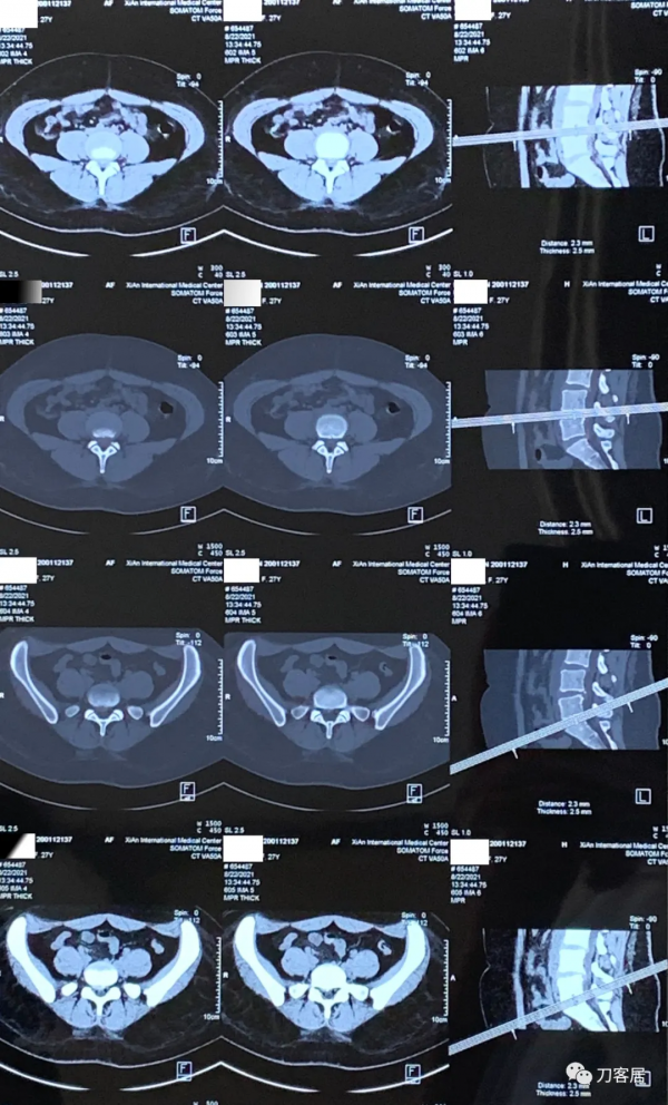 27歲女性，兩間隙腰椎間盤突出症，6顆釘子，4個融合器