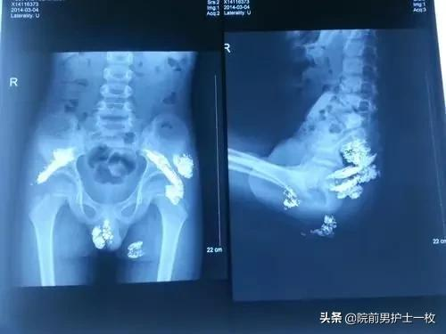 關於汞中毒的緊急處置