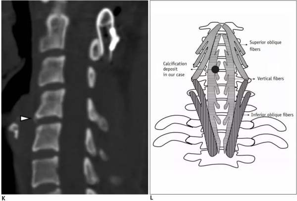 頸椎少見的3種鈣化性疾病 頸椎少見的3種鈣化性疾病