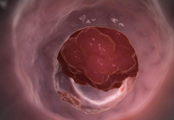 醫生眼裡常見的6種&OpenCurlyDoubleQuote;瘤&rdquo;，確診後千萬別害怕，惡化的機率很小