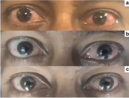 COVID-19眼部感染，何為真？何為假？丨APVRS 2021