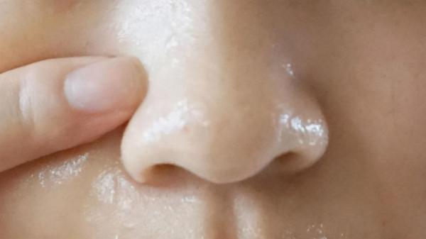 鼻頭長痘痘又紅又腫是什麼原因？