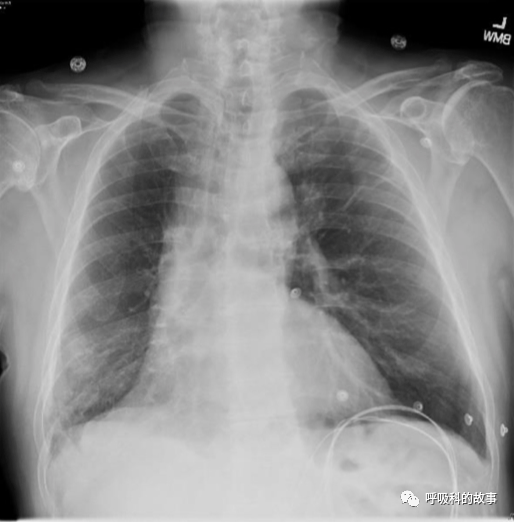 62歲男性患者呼吸急促、乾咳3個月，卻被誤診3個月，這樣的事件你能接受嗎？