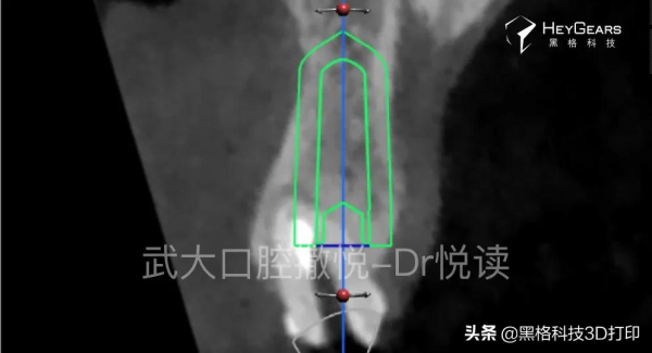 黑格科技丨病例分享：美學區即拔即種微創治療