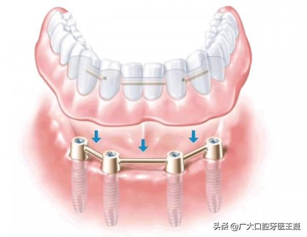 過來人告訴你,多顆牙齒缺失,這個辦法更省錢、效果更好 過來人告訴你,多顆牙齒缺失,這個辦法更省錢、效果更好