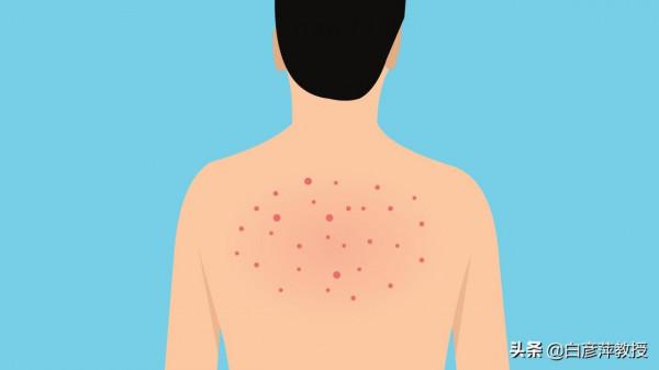 面板癢疹?又抓又撓,都無法控制的癢?或是癢疹在“作祟” 面板癢疹?又抓又撓,都無法控制的癢?或是癢疹在“作祟”