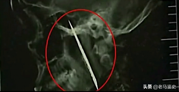 雲南30歲男子口臭駭人，只因&quot;腦中藏10釐米長刀&quot;，最終結局如何？