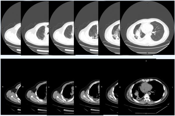 多線治療後復發的PD-L1陰性晚期肺鱗癌,替雷利珠單抗聯合化療帶來有效緩解 多線治療後復發的PD-L1陰性晚期肺鱗癌,替雷利珠單抗聯合化療帶來有效緩解