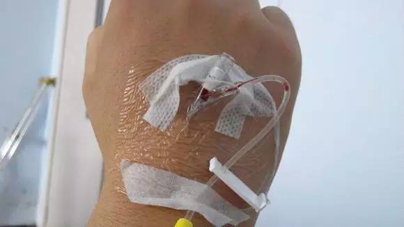 你扎的留置針為何一天就堵管了？這篇經驗貼幫到你