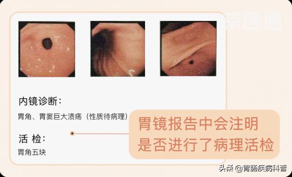 3分鐘看懂——胃鏡報告 3分鐘看懂——胃鏡報告