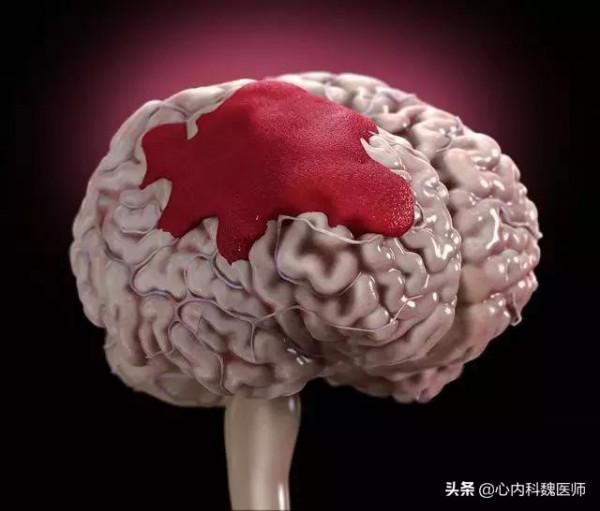 突發腦出血怎麼辦？醫生教您急救方法，有高血壓、高血糖的請收藏